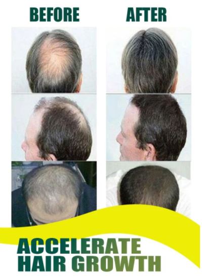 Hair regrowth ginger spray️