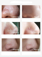 Mee-eterverwijderaar ClearSkin – Liva
