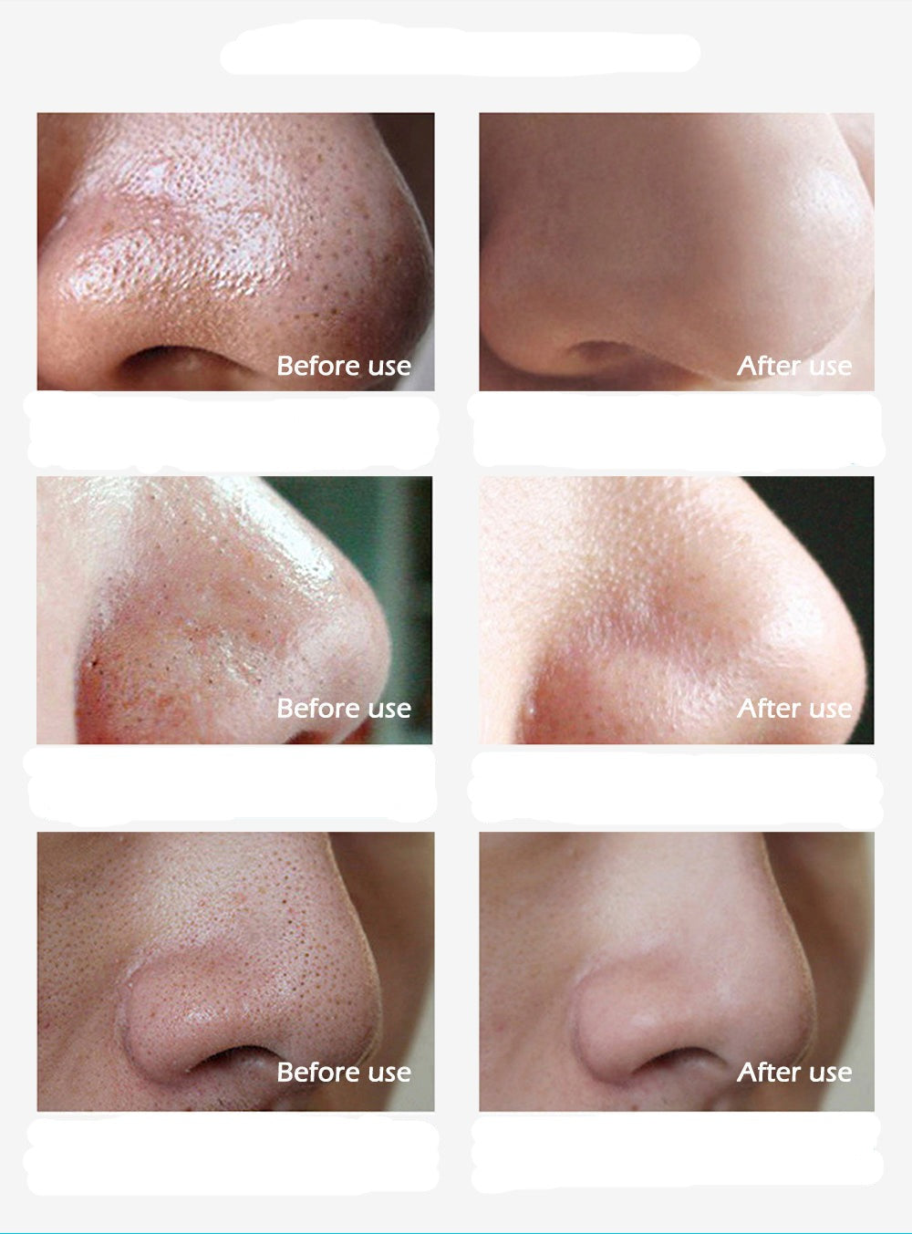 Mee-eterverwijderaar ClearSkin – Liva